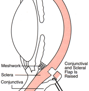 Diagram showing surgery for glaucoma