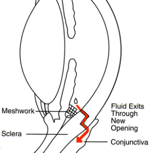 Diagram showing how fluid flows from the eye after surgery